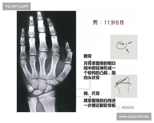 哪种测骨龄法最准 哪种测骨龄法最准